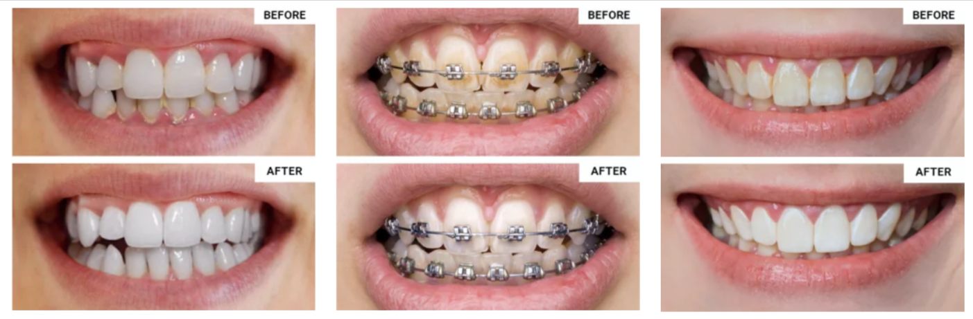 WellaWhite Water Flosser overall customer